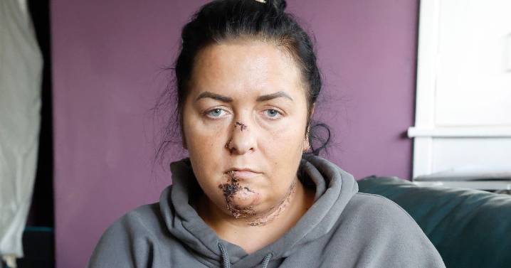 Coatbridge mum and daughter left with facial injuries after bully dog attack