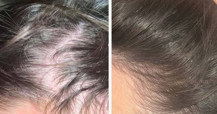 Shoppers with thinning hair 'notice much less loss' thanks to supplement bundle