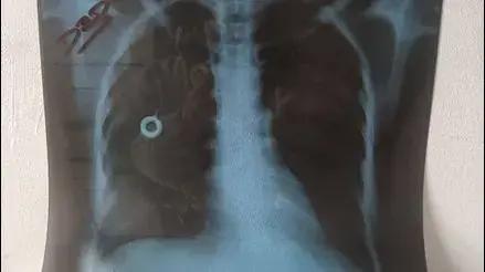 Puente Piedra: mujer pide que le retiren catéter que pone en riesgo sus pulmones