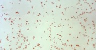 Sexually transmitted disease cases fall, but not syphilis in newborns