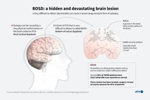 AI tool helps researchers treat child epilepsy