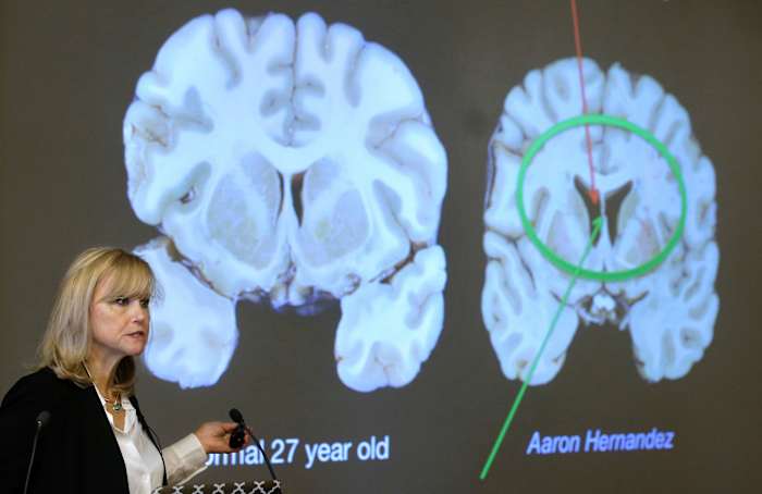 Here's what to know about CTE, the brain disease the NYC shooter blamed for his mental health issues