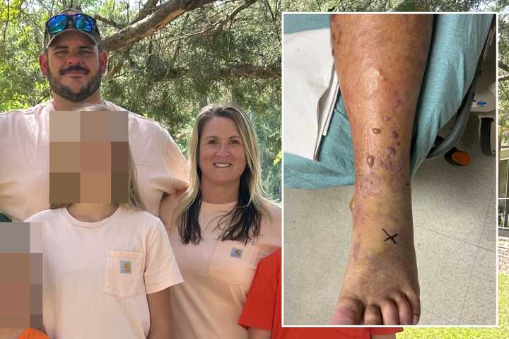 ‘Healthy’ dad left moments from death after ankle blister morphed into flesh-eating infection that shut down his organs