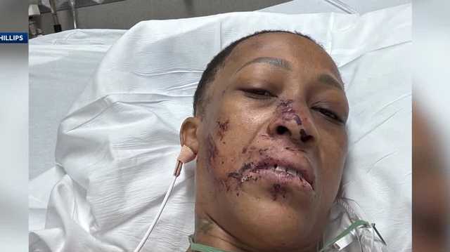 Osceola County hit-and-run victim says she was left to die