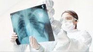 Se disparan casos de tuberculosis en Nuevo Laredo; IMSS Bienestar registra aumento del 30%