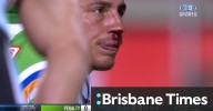Raiders prop bleeds from high shot