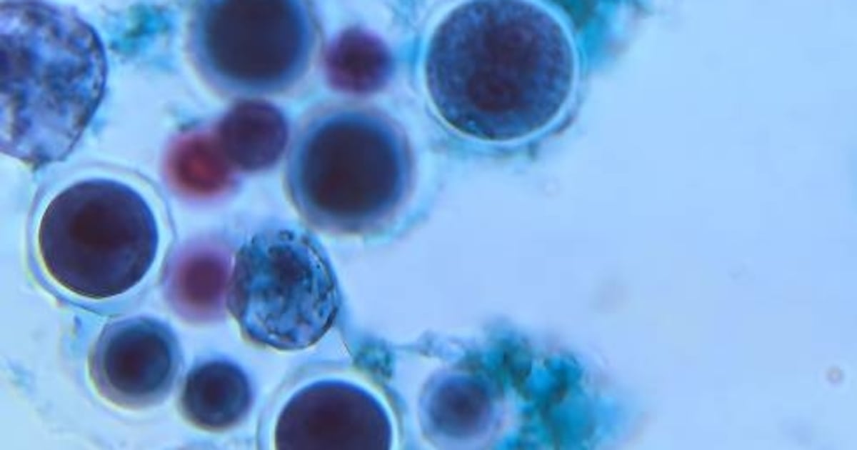 Huntington’s Disease is Treated for the First Time in Gene Therapy Trial