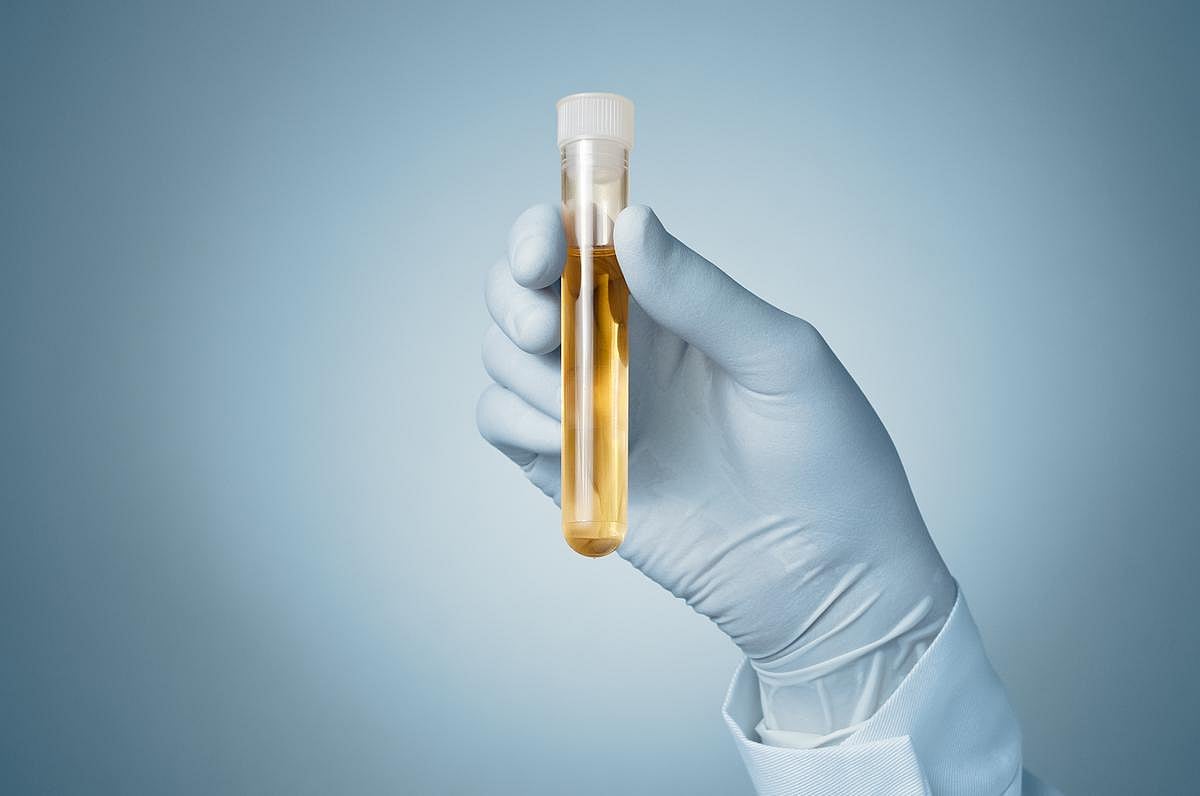 Urine Biomarker Panel Sensitive, Specific for Prostate Cancer Diagnosis