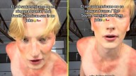 "No es ninguna broma": Influencer finlandés muestra cómo quedó tras quemarse con el sol en Chile