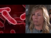 Survivor of flesh-eating bacteria speaks out: "Just thankful to be here"