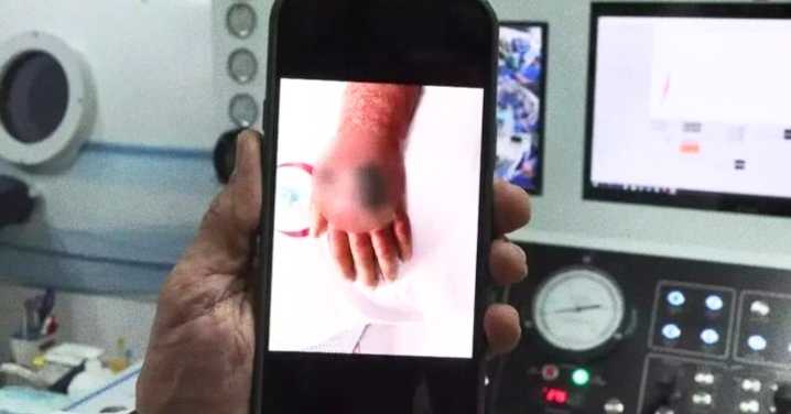 Shopkeeper Nearly Loses Arm After Thief Bites Them