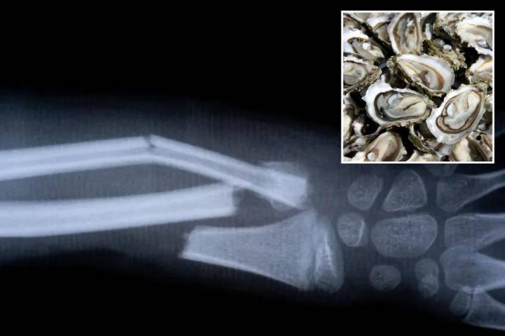 China made Bone 02 glue fixes fractures in just three minutes with one injection