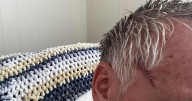 Davich: Skin cancer scare for me, crucial takeaways for you