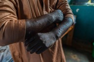 Whatever happened to mpox? Is it still a threat?