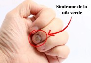 Alertan por el síndrome de la uña verde