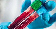 Q&A: Broader reach of blood-based biomarkers for Alzheimer’s can shift dynamics of access