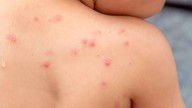 Alerta: confirmaron dos casos de viruela de mono en Salta