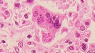 Child dies from measles complications