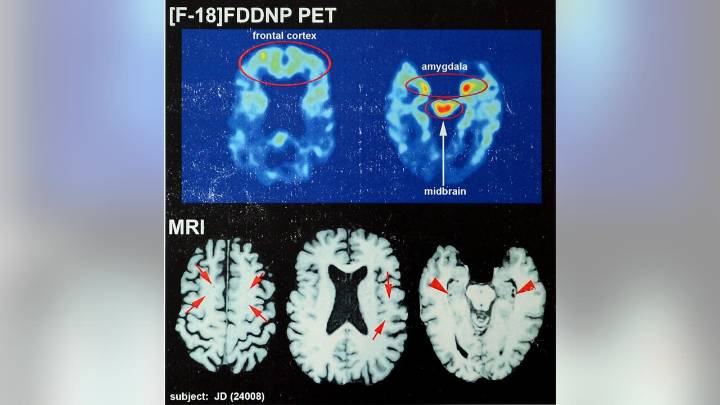 Study reveals pre-CTE damage in brains of even young contact