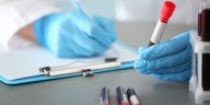 Investigadores: Demasiado pronto para saber si las 'biopsias líquidas' ayudan en vez de perjudicar en la detección del cáncer