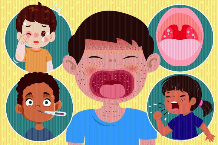 The 8 early signs of measles that appear pre-rash every parent should be aware of as new school term starts