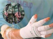 Hospital Militar reporta estado crítico de subteniente quemado en Putumayo