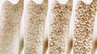 FDA Approves Fifth Set of Biosimilars of Prolia/Xgeva