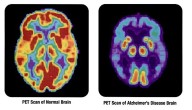 Tiny Protein Confirmed to Dismantle the Toxic Clumps Linked to Alzheimer’s Disease