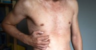 Viruela del mono: los dos pacientes evolucionan y realizan bloqueos