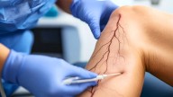 Adultos mayores, el hábito que muchos ignoran y promueve la aparición de várices