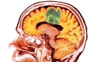 Targeting ADAR1 in Glioblastoma Slows Tumor Growth and Reignites Immune Response