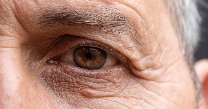 Analysis finds predictors of poorer acute optic neuritis outcomes