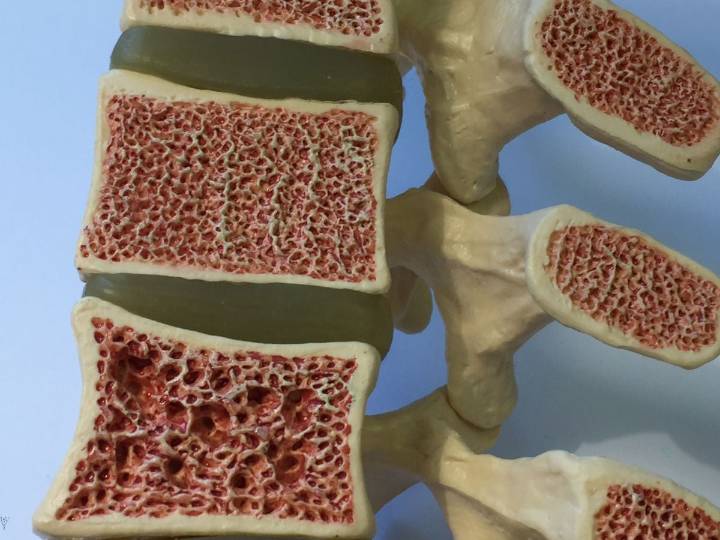 Nuevo avance para fortalecer los huesos podría revertir la osteoporosis