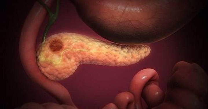 Científicos desarrollan un algoritmo que predice la metástasis en cáncer de páncreas