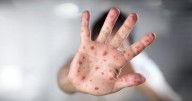 México concentra casi 40% de casos de sarampión en el Continente Americano