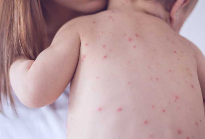 Sarampión y varicela: Salud advierte baja cobertura en niños y pide acudir a vacunatorios
