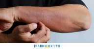 Dermatitis atópica: cómo afecta no iniciar el tratamiento a tiempo