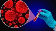 Mieloma múltiple, un cáncer sigiloso