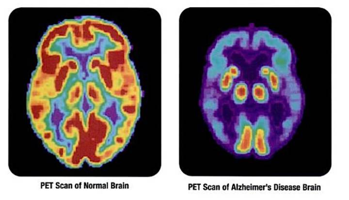 Tiny Protein Confirmed to Dismantle the Toxic Clumps Linked to Alzheimer’s Disease