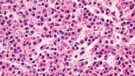 Especialistas advierten que Mieloma Múltiple sigue siendo diagnosticado tardíamente