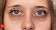 Dark circles under your eyes may reveal signs of kidney failure, liver disease, and more