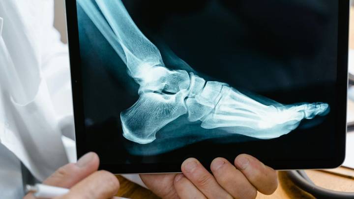 Científicos desarrollan un "pegamento óseo" capaz de reparar fracturas de huesos en tan solo unos minutos