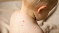 Clade 1 Mpox Virus Detected in US Wastewater; How High Is the Risk of Catching The Virus?