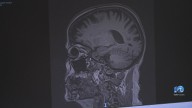 Experts: Alzheimer’s prevention drug could be close