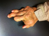 Startup Crystalys Therapeutics Emerges With $205M to Fill a Growing Gap in Gout Treatment