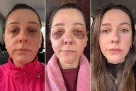 Woman Shares Bleph Surgery Results in Viral TikToks. See Her Before