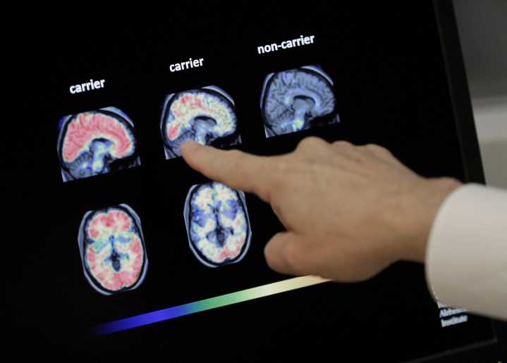 Doctors in Virginia say focused ultrasound could soon be used as a treatment for addiction