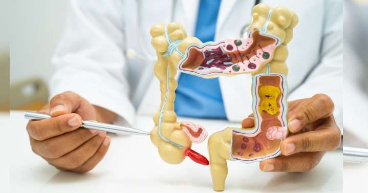 Cáncer de colon: ¿por qué la diarrea o el estreñimiento no deben ignorarse?