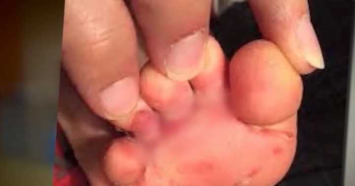 MSCS confirms 'several' cases of Hand, Foot and Mouth Disease at Memphis elementary school