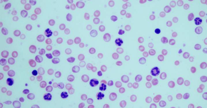 En 2026 se diagnosticarán 28.000 nuevos casos de cáncer sanguíneo en España
